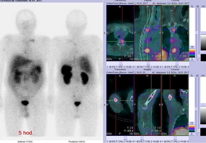 Obr. č. 2: Celotělová scintigrafie v přední a zadní projekci a fúze obrazů SPECT a CT. Vyšetření 5 hod. po aplikaci radioindikátoru