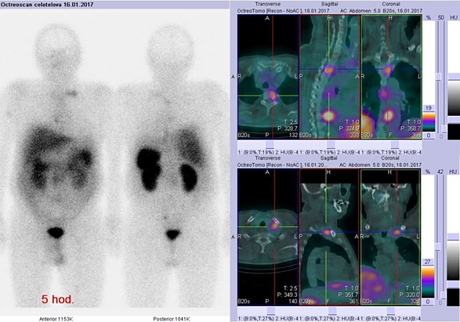 Obr. č. 3: Celotělová scintigrafie v přední a zadní projekci a fúze obrazů SPECT a CT. Vyšetření 5 hod. po aplikaci radioindikátoru
