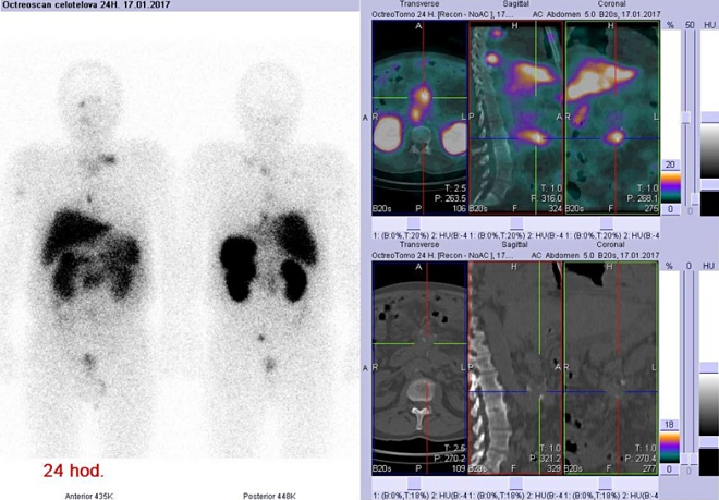 Obr. č. 5: Celotělová scintigrafie v přední a zadní projekci a fúze obrazů SPECT a CT. Vyšetření 24 hod. po aplikaci radioindikátoru.