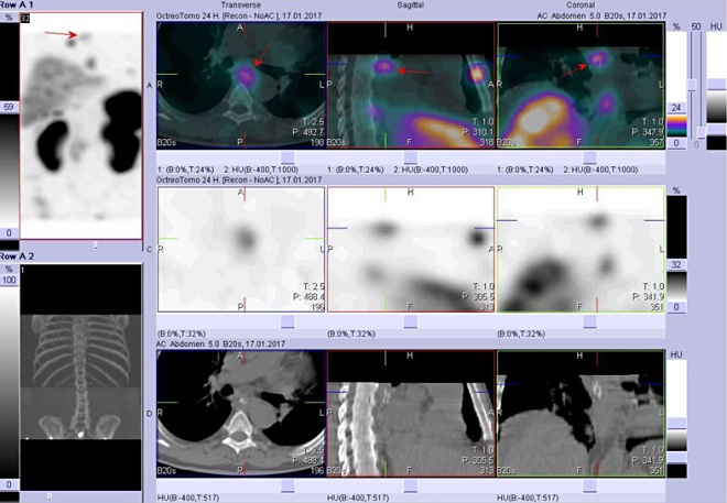 Obr. č. 7: Vpravo nahoře fúze SPECT a CT, vpravo uprostřed SPECT, vpravo dole CT.