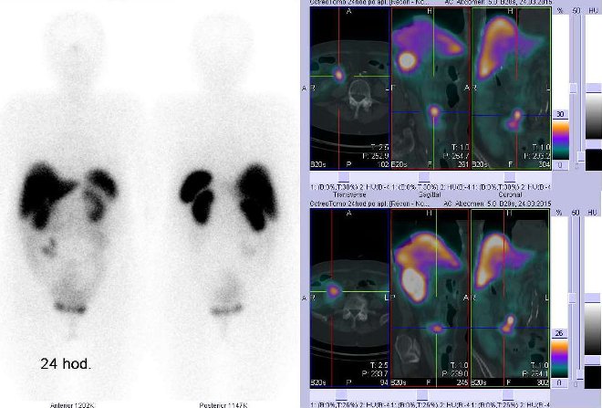 Obr.1: Celotělová scintigrafie v přední a zadní projekci a fúze SPECT/CT 24 hod. po aplikaci OctreoScanu. Zaměřeno na ložiska v pravém mesogastriu.