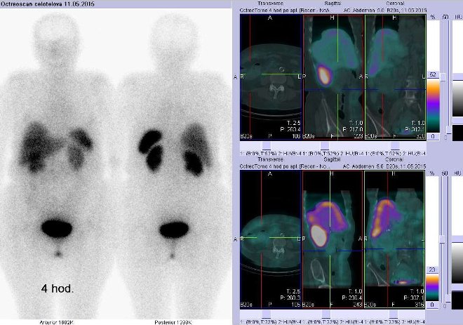 Obr.č.2: Celotělová scintigrafie v přední a zadní projekci a fúze SPECT/CT 4 hod. po aplikaci OctreoScanu. Zaměřeno na pravé mesogastrium.