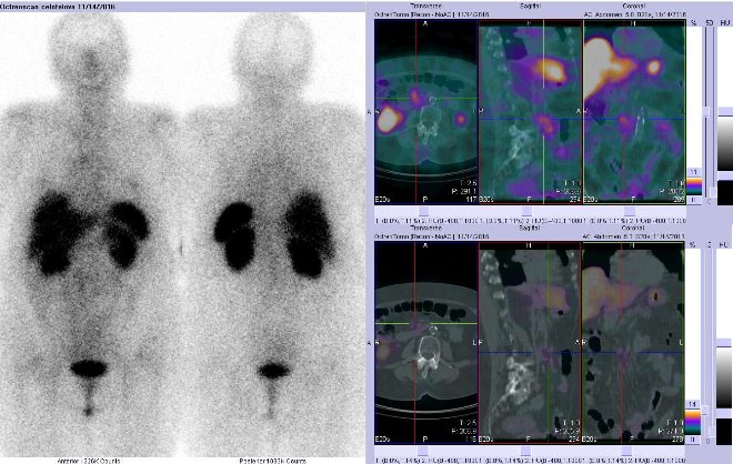Obr. č. 4: Celotělová scintigrafie v přední a zadní projekci a fúze SPECT/CT 5 hod. po aplikaci OctreoScanu. Zaměřeno na pravé mesogastrium.