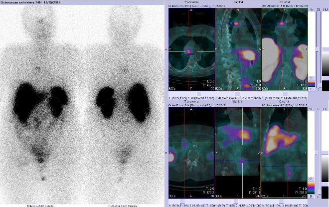 Obr. č. 5: Celotělová scintigrafie v přední a zadní projekci a fúze SPECT/CT 24 hod. po aplikaci OctreoScanu. Zaměřeno na ložisko v hrudníku těsně vpravo od střední čáry.