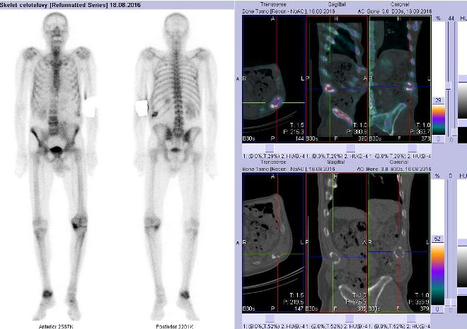 Obr. č. 1: Celotělová scintigrafie v přední a zadní projekci a fúze obrazů SPECT a CT. Vpravo fúze obrazů SPECT a CT - zaměřeno na ložisko v 11. žebru vlevo. Řezy transverzální, sagitální a koronální.