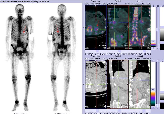 Obr. č. 2: Celotělová scintigrafie v přední a zadní projekci a fúze obrazů SPECT a CT. Vpravo fúze obrazů SPECT a CT - zaměřeno na nádorovou recidivu v lůžku po levostranné nefrektomii. Řezy transverzální, sagitální a koronální.