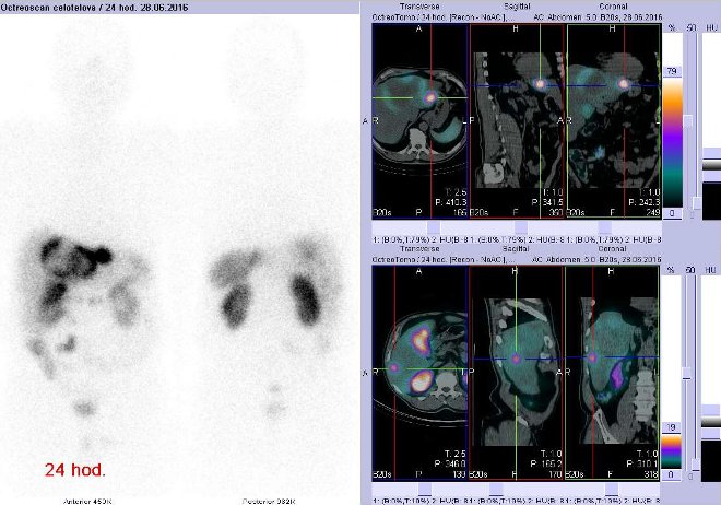 Obr. č. 2: Celotělová scintigrafie v přední a zadní projekci a fúze obrazů SPECT a CT. Vyšetření 24 hod. po aplikaci radioindikátoru. Vpravo nahoře zaměřeno na ložisko v levém jaterním laloku, vpravo dole zaměřeno na ložisko v pravém jaterním laloku.