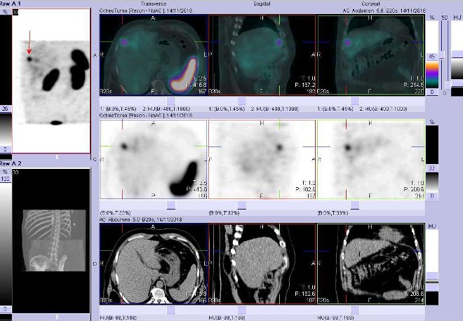 Obr. č. 2: Fúze obrazů SPECT a CT. Vyšetření 5 hod. po aplikaci radioindikátoru. Zaměřeno na ložisko ve ventrolaterální části pravého jaterního laloku.