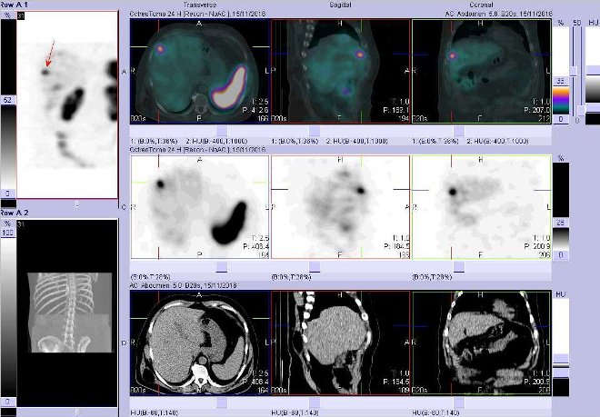 Obr. č. 3: Fúze obrazů SPECT a CT. Vyšetření 24 hod. po aplikaci radioindikátoru. Zaměřeno na ložisko ve ventrolaterální části pravého jaterního laloku.