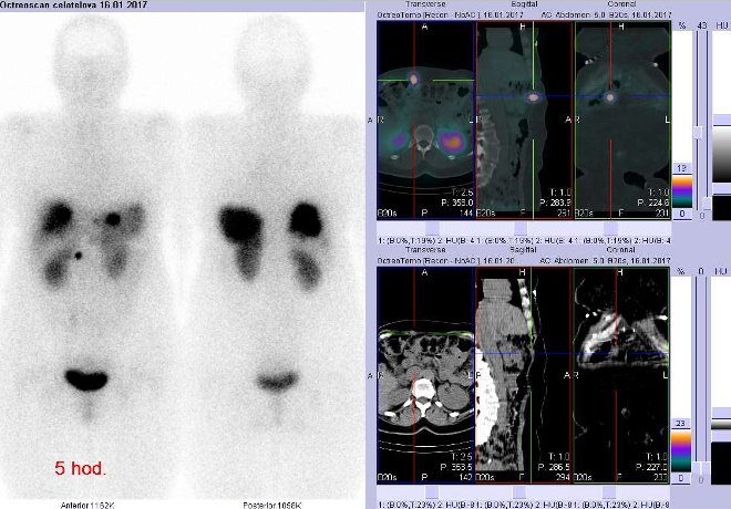 Obr.1: Celotělová scintigrafie v přední a zadní projekci a fúze obrazů SPECT a CT. Vyšetření 5 hod. po aplikaci radioindikátoru. Vpravo zaměřeno na ložisko povrchově v břišní stěně vpravo.