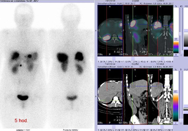 Obr.3: Celotělová scintigrafie v přední a zadní projekci a fúze obrazů SPECT a CT. Vyšetření 5 hod. po aplikaci radioindikátoru. Vpravo zaměřeno na ložisko v pravém laloku dorzálně.