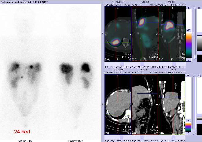 Obr. č. 4: Celotělová scintigrafie v přední a zadní projekci a fúze obrazů SPECT a CT. Vyšetření 24 hod. po aplikaci radioindikátoru. Vpravo zaměřeno na ložisko v pravém laloku dorzálně.