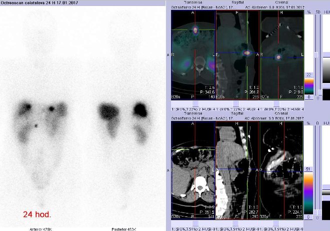 Obr. č. 5: Celotělová scintigrafie v přední a zadní projekci a fúze obrazů SPECT a CT. Vyšetření 24 hod. po aplikaci radioindikátoru. Vpravo zaměřeno na ložisko povrchově v břišní stěně vpravo.