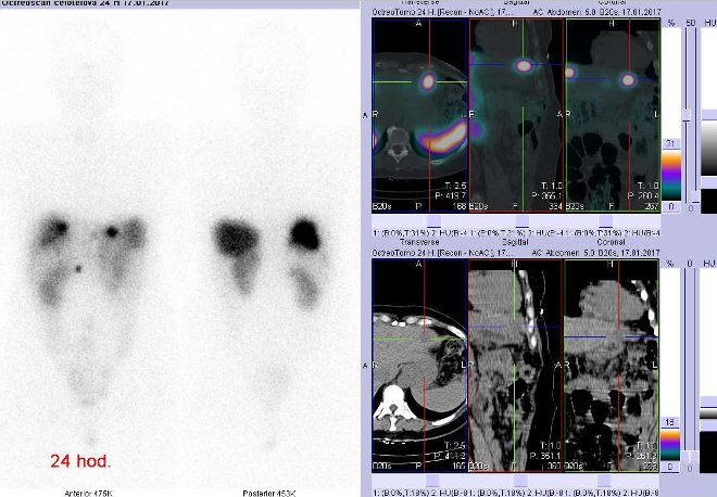 Obr. č. 6: Celotělová scintigrafie v přední a zadní projekci a fúze obrazů SPECT a CT. Vyšetření 24 hod. po aplikaci radioindikátoru. Vpravo zaměřeno na ložisko v levém jaterním laloku.