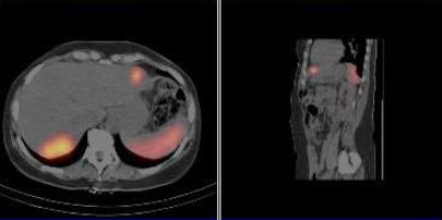 Obr. č. 7: Fúze obrazů SPECT a CT – vyšetření břicha a dolní části hrudníku 24 hod. po aplikaci radiofarmaka. Patrné ložisko v levém jaterním laloku a v dorzální části pravého laloku jater.