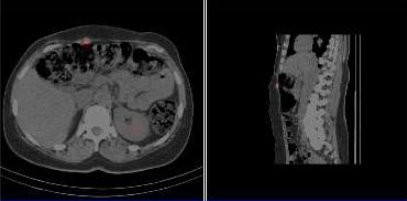 Obr. č. 8: Fúze obrazů SPECT a CT – vyšetření břicha a dolní části hrudníku 24 hod. po aplikaci radiofarmaka. Patrné ložisko povrchově v břišní stěně vpravo.