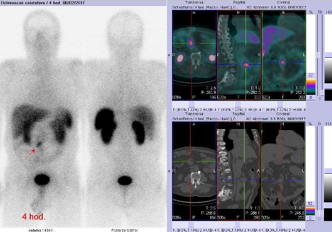 Obr.č.1: Celotělová scintigrafie v přední a zadní projekci a fúze obrazů SPECT a CT. Vyšetření 4 hod. po aplikaci radioindikátoru. Vpravo zaměřeno na ložisko v mesogastriu vpravo od střední čáry.