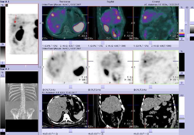 Obr. č. 3: Fúze obrazů SPECT a CT – vyšetření břicha a pánve 4 hod. po aplikaci radiofarmaka. Vpravo nahoře fúze SPECT a CT, vlevo uprostřed SPECT, vlevo dole CT. Zaměřeno na ložisko ve ventrolaterální části pravého jaterního laloku.