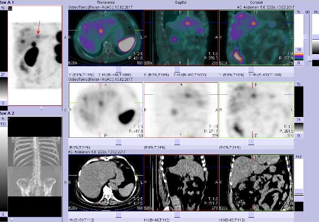 Obr. č. 4: Fúze obrazů SPECT a CT – vyšetření břicha a pánve 4 hod. po aplikaci radiofarmaka. Vpravo nahoře fúze SPECT a CT, vlevo uprostřed SPECT, vlevo dole CT. Zaměřeno na ložisko na rozhraní obou jaterních laloků.