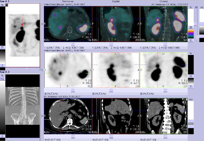 Obr. č. 5: Fúze obrazů SPECT a CT – vyšetření břicha a pánve 4 hod. po aplikaci radiofarmaka. Vpravo nahoře fúze SPECT a CT, vlevo uprostřed SPECT, vlevo dole CT. Zaměřeno na ložisko v dorzomediální části pravého jaterního laloku.
