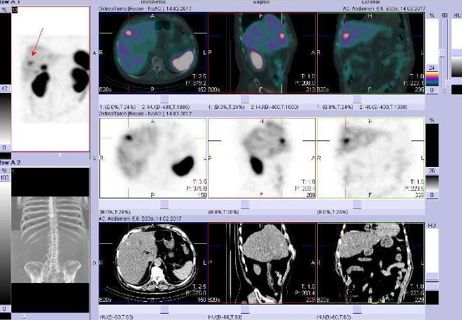 Obr. č. 6: Fúze obrazů SPECT a CT – vyšetření břicha a pánve 24 hod. po aplikaci radiofarmaka. Vpravo nahoře fúze SPECT a CT, vlevo uprostřed SPECT, vlevo dole CT. Zaměřeno na ložisko ve ventrolaterální části pravého jaterního laloku.
