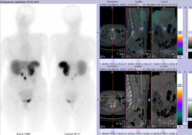 Obr. č. 2: Celotělová scintigrafie v přední a zadní projekci a fúze obrazů SPECT a CT. Zaměřeno na ložisko v epigastriu. Vyšetření 4 hod. po aplikaci radioindikátoru.