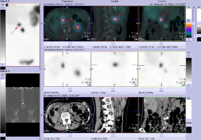 Obr. č. 4: Fúze obrazů SPECT a CT. Zaměřeno na ložisko v pravém mesogastriu. Vyšetření 4 hod. po aplikaci radioindikátoru.