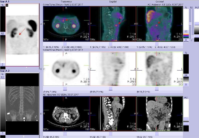 Obr. č. 2: Fúze obrazů SPECT a CT – vyšetření břicha a části pánve 4 hod. po aplikaci radiofarmaka. Vpravo nahoře fúze SPECT a CT, vpravo uprostřed SPECT, vpravo dole CT. Zaměřeno na ložisko v pravém mesogastriu.