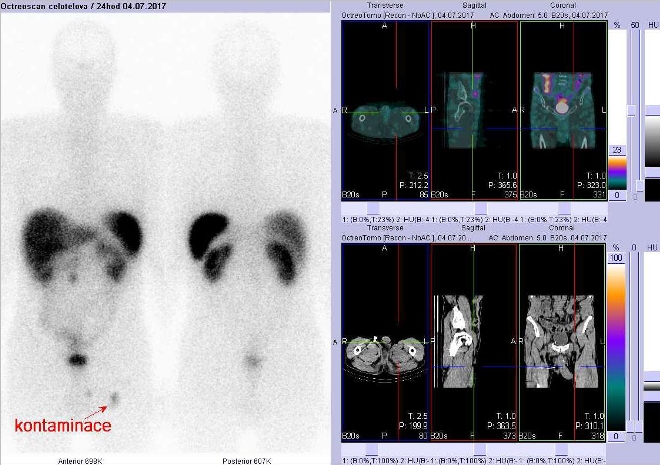 Obr. č. 3: Celotělová scintigrafie v přední a zadní projekci a fúze obrazů SPECT a CT. Vyšetření 24 hod. po aplikaci radioindikátoru. Po celotělové scintigrafii následovalo umytí inguinálních oblastí a stehen a poté na SPECT/CT vymizení ložiska kontaminace. Vpravo zaměřeno na inguinální oblasti, vpravo nahoře fúze SPECT/CT, vpravo dole CT.