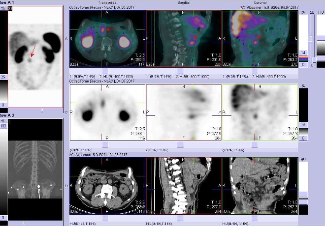 Obr.č.4: Fúze obrazů SPECT a CT – vyšetření břicha a části pánve 24 hod. po aplikaci radiofarmaka. Vpravo nahoře fúze SPECT a CT, vpravo uprostřed SPECT, vpravo dole CT. Zaměřeno na ložisko v pravém mesogastriu.