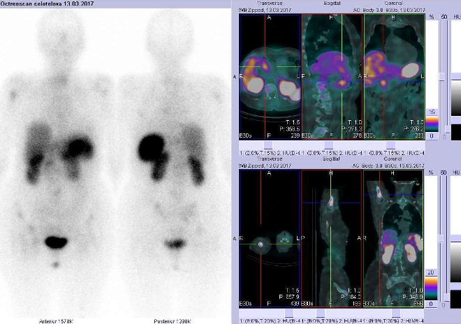Obr. č. 4: Celotělová scintigrafie v přední a zadní projekci a fúze SPECT/CT se zaměřením na jaterní ložisko - vpravo nahoře - a na metastázu v proximální části pravé pažní kosti - vpravo dole - 4 hod. po aplikaci OctreoScanu.