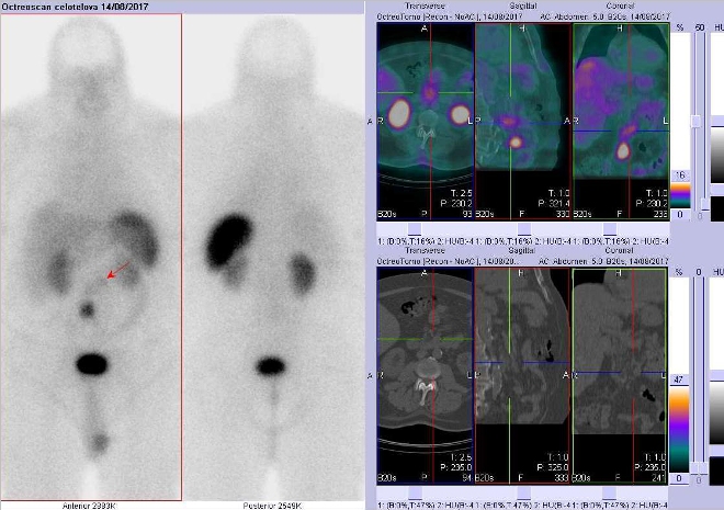 Obr. č. 3: Celotělová scintigrafie a fúze SPECT/CT břicha 4 hod. po aplikaci OctreoScanu. Zaměřeno na málo aktivní ložisko v duodenu.