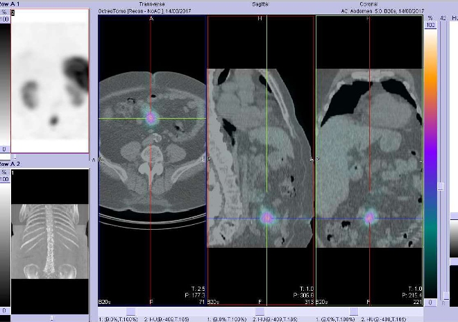 Obr. č. 4: Fúze SPECT/CT břicha 4 hod. po aplikaci OctreoScanu. Zaměřeno na ložisko v mezenteriu v blízkosti pupku.