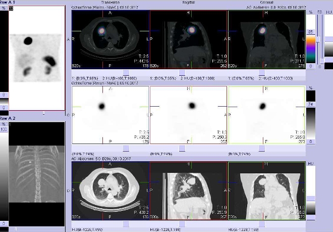 Obr. č. 5: Fúze obrazů SPECT a CT. Vyšetření 4 hod. po aplikaci radioindikátoru. Zaměřeno na ložisko v pravé plíci parahilozně.