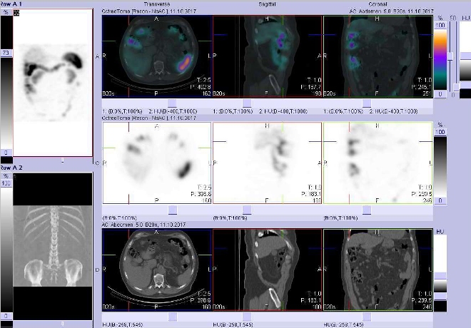 Obr. č. 6: Fúze obrazů SPECT a CT. Vyšetření 48 hod. po aplikaci radiofarmaka. Zaměřeno na radioaktivitu v tlustém střevě – oblast hepatální flexury.