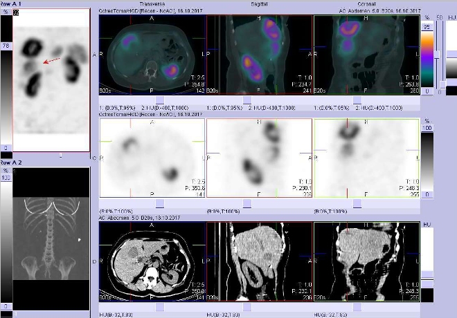 Obr. č. 2: Fúze obrazů SPECT a CT. Vyšetření 4 hod. po aplikaci radiofarmaka. Zaměřeno na ložisko s nekrózou  ve ventrální části pravého jaterního laloku.