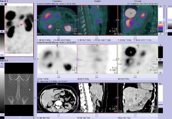 Obr. č. 6: Fúze obrazů SPECT a CT. Vyšetření 4 hod. po aplikaci radiofarmaka. Zaměřeno na ložisko  v levém jaterním laloku.