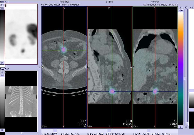 Obr. č. 4: Fúze SPECT/CT břicha 4 hod. po aplikaci OctreoScanu. Zaměřeno na ložisko v mezenteriu v blízkosti pupku.