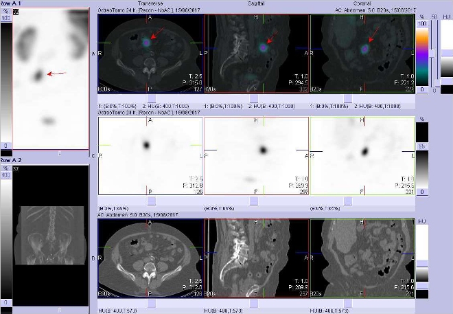 Obr. č. 5: Fúze SPECT/CT břicha a pánve 24 hod. po aplikaci OctreoScanu. Zaměřeno na ložisko v mezenteriu v blízkosti pupku.
