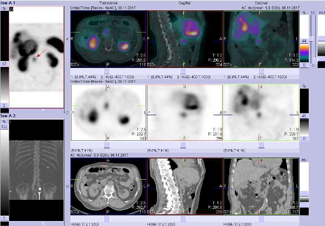 Obr. č. 2: Fúze obrazů SPECT a CT. Vyšetření 4 hod. po aplikaci radioindikátoru. Zaměřeno na ložisko v hlavě pankreatu.