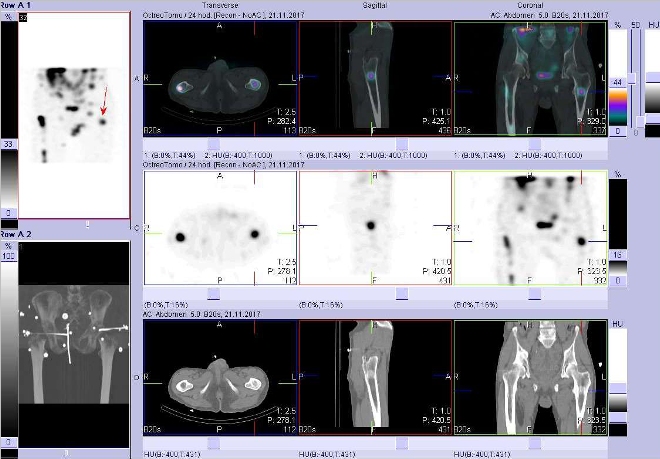 Obr. č. 10: Fúze obrazů SPECT a CT. Vyšetření 24 hod. po aplikaci radioindikátoru. Zaměřeno na ložisko v levé stehenní kosti.