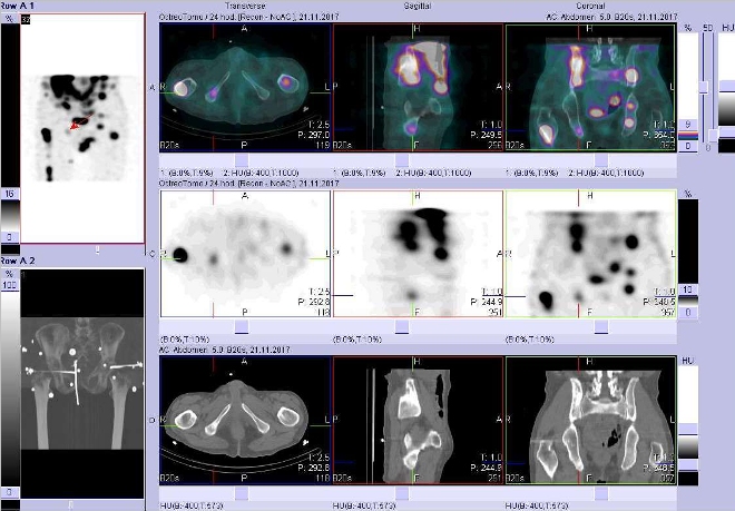 Obr. č. 12: Fúze obrazů SPECT a CT. Vyšetření 24 hod. po aplikaci radioindikátoru. Zaměřeno na ložisko v pravé části pánve.