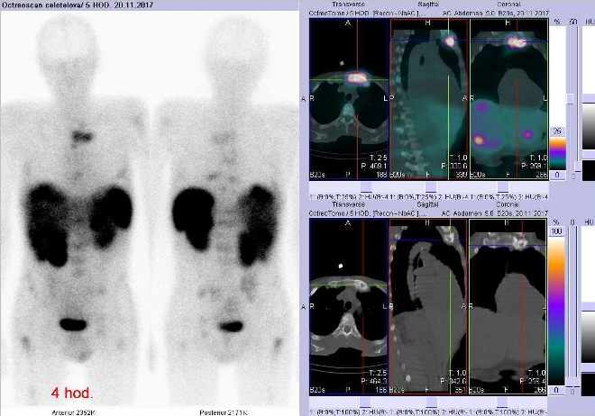 Obr.3: Celotělová scintigrafie v přední a zadní projekci a fúze obrazů SPECT a CT. Vyšetření 4 hod. po aplikaci radioindikátoru. Vpravo zaměřeno na ložisko v levém sternoklavikulárním skloubení.