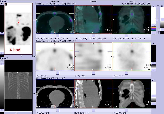 Obr. č. 5: Fúze obrazů SPECT a CT. Vyšetření 4 hod. po aplikaci radioindikátoru. Zaměřeno na ložisko ve sternu.