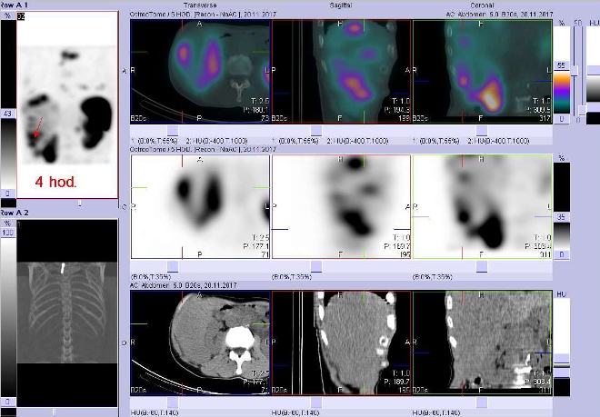 Obr. č. 8: Fúze obrazů SPECT a CT. Vyšetření 4 hod. po aplikaci radioindikátoru. Zaměřeno na ložisko v distální části pravého jaterního laloku.