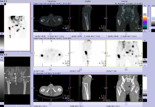 Obr. č. 9: Fúze obrazů SPECT a CT. Vyšetření 24 hod. po aplikaci radioindikátoru. Zaměřeno na ložisko v pravé stehenní kosti.