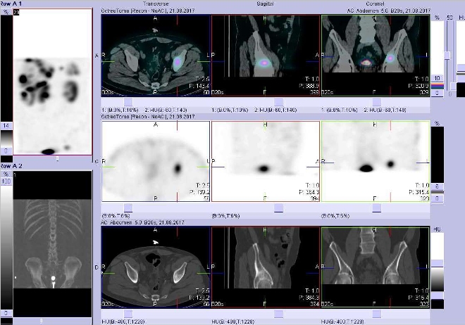 Obr. č. 4: Fúze obrazů SPECT a CT. Vyšetření 4 hod. po aplikaci radioindikátoru. Zaměřeno na ložisko v kosti kyčelní vlevo nad acetabulem.
