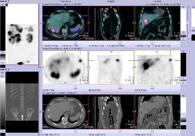 Obr. č. 5: Fúze obrazů SPECT a CT. Vyšetření 4 hod. po aplikaci radioindikátoru. Zaměřeno na ložisko v žebru vlevo ventrálně.