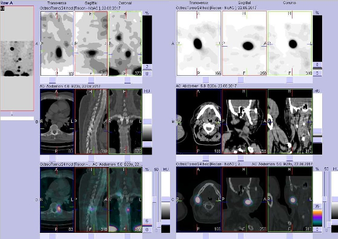Obr. č. 6: Fúze obrazů SPECT a CT. Vyšetření 24 hod. po aplikaci radioindikátoru. Zaměřeno na ložisko v hrudním obratli a v krční uzlině vpravo.