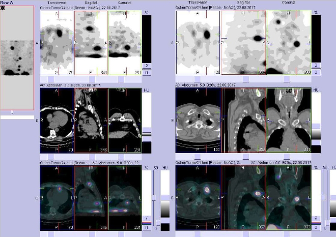 Obr. č. 8: Fúze obrazů SPECT a CT. Vyšetření 24 hod. po aplikaci radioindikátoru. Zaměřeno na ložisko v mediastinu na perikardu ventrálně a v klíční kosti vlevo mediálně.